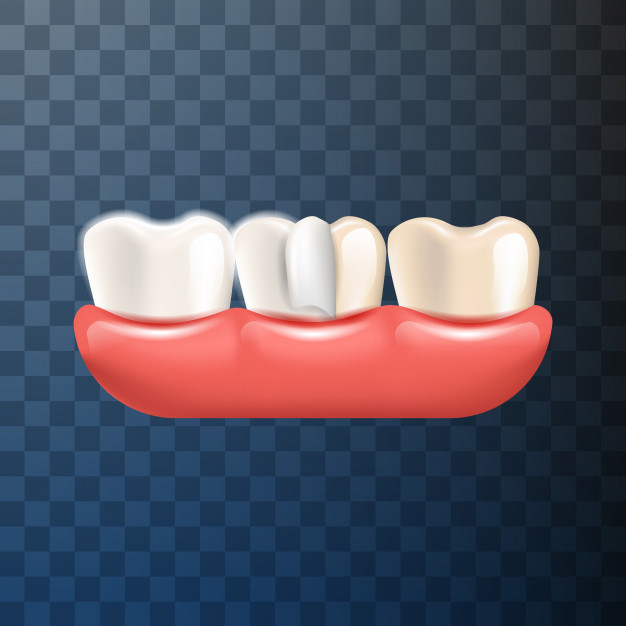 All You Need to Know About Dental Veneer - Dental Guide All You Need to Know About Dental Veneer - Dental Guide